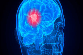 Head surgery in Nashik | Brain tumor surgery in Nashik - Dr.Sanjeev Desai