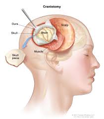 Head surgery in Nashik | Brain tumor surgery in Nashik - Dr.Sanjeev Desai