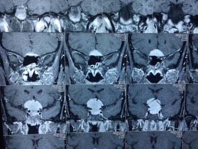 Head surgery in Nashik | Brain tumor surgery in Nashik - Dr.Sanjeev Desai