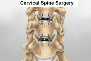 Spine Surgery in Nashik