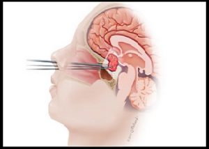 brain tumour surgery in Nashik