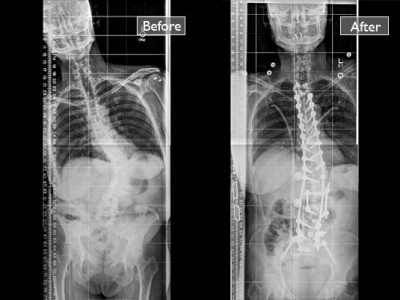 Spine surgery in Nashik