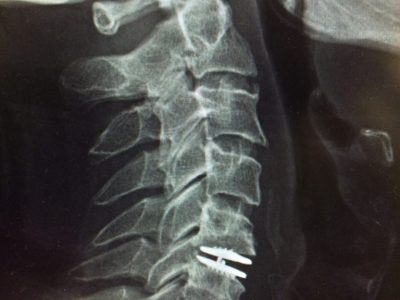 Spine Surgery in Nashik